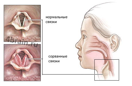Когда садится голос чем лечить в домашних условиях Когда садится голос чем лечить в домашних